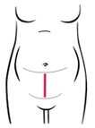 Incision abdominal