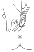EPISIOTOMÍA MEDIOLATERAL