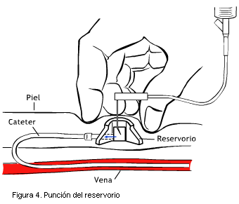 Figura 4. Punción del reservorio