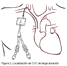 Figura 2. Localización de CVC de larga duración