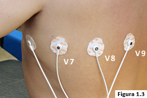 Figura 1.3: Colocación electrodos derivaciones izquierdas posteriores